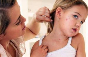 Кір: симптоми, динаміка, ускладнення хвороби