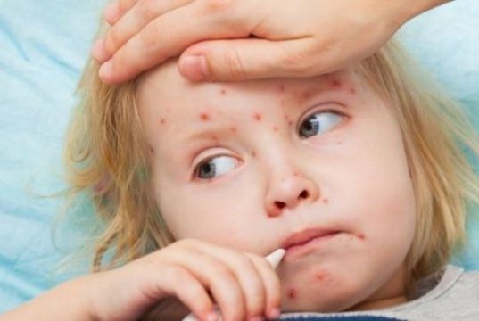 Ситуація із захворюваністю на кір – напружена